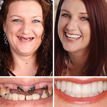 Ends Today: 70% OFF! ⏰70% OFF! EETTSY™ Medical Full Denture with Strong Suctiond Custom-Fit Full Functional Dentures🦷Obtain American Dental Association (ADA) Certification